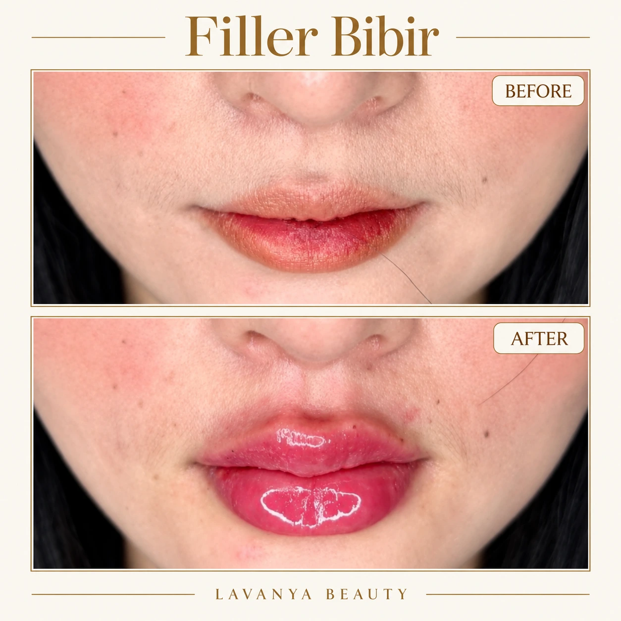 Perbandingan sebelum dan sesudah Filler Bibir