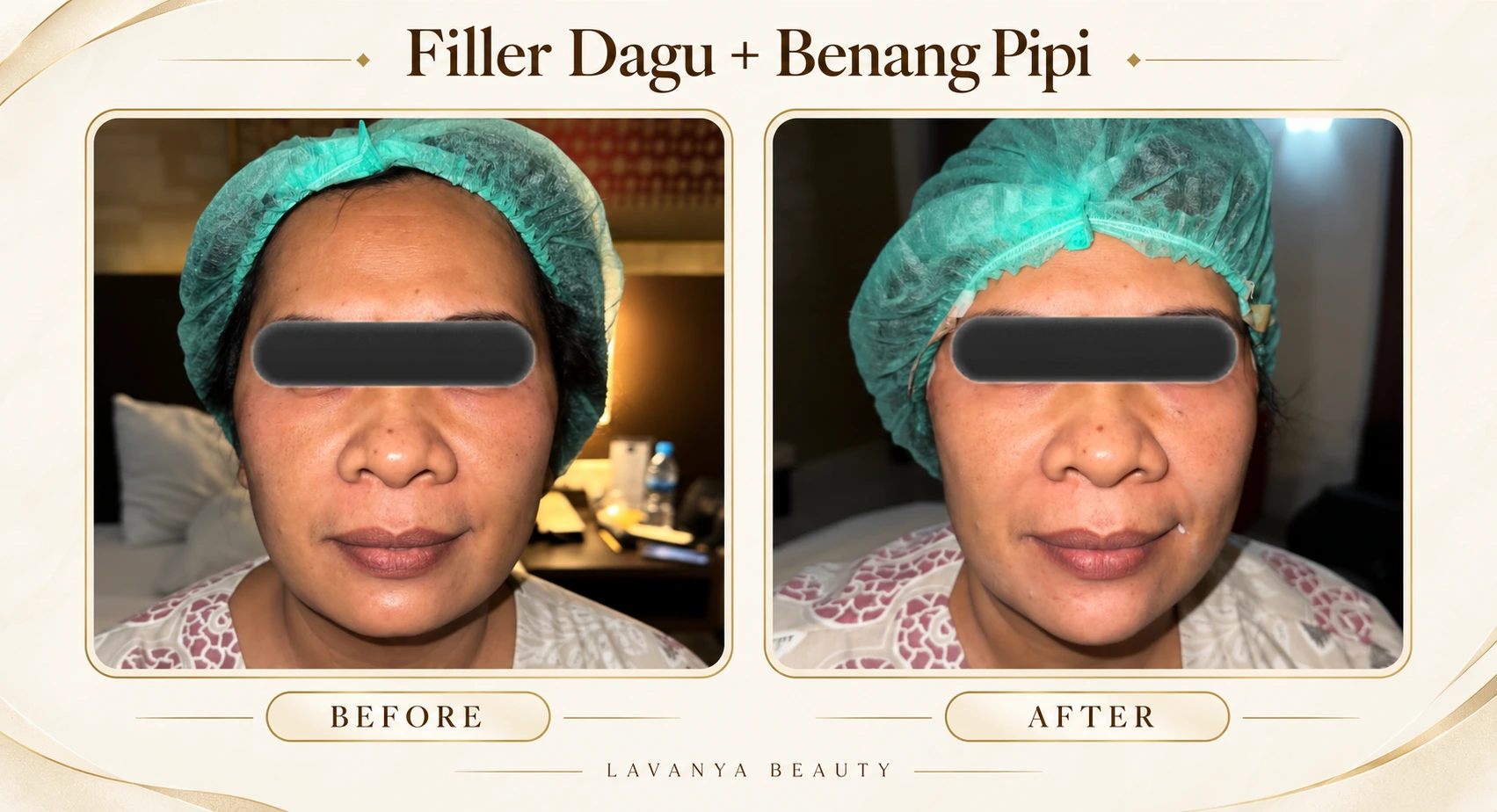 Perbandingan sebelum dan sesudah Filler Dagu + Benang Pipi