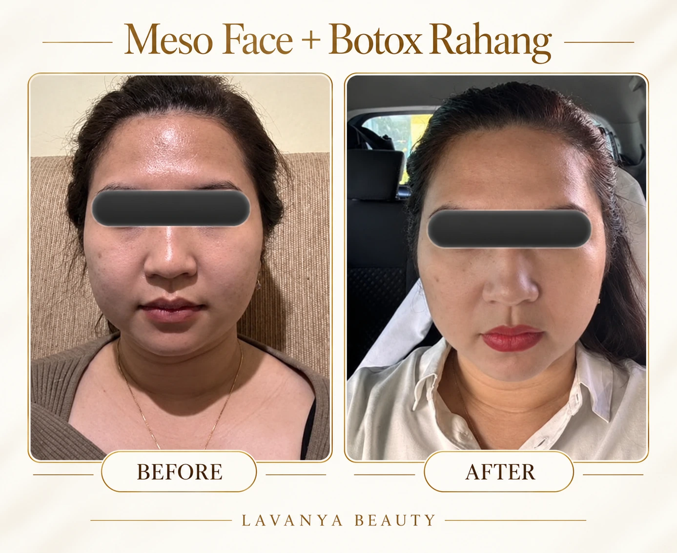 Perbandingan sebelum dan sesudah Meso Face + Botox Rahang