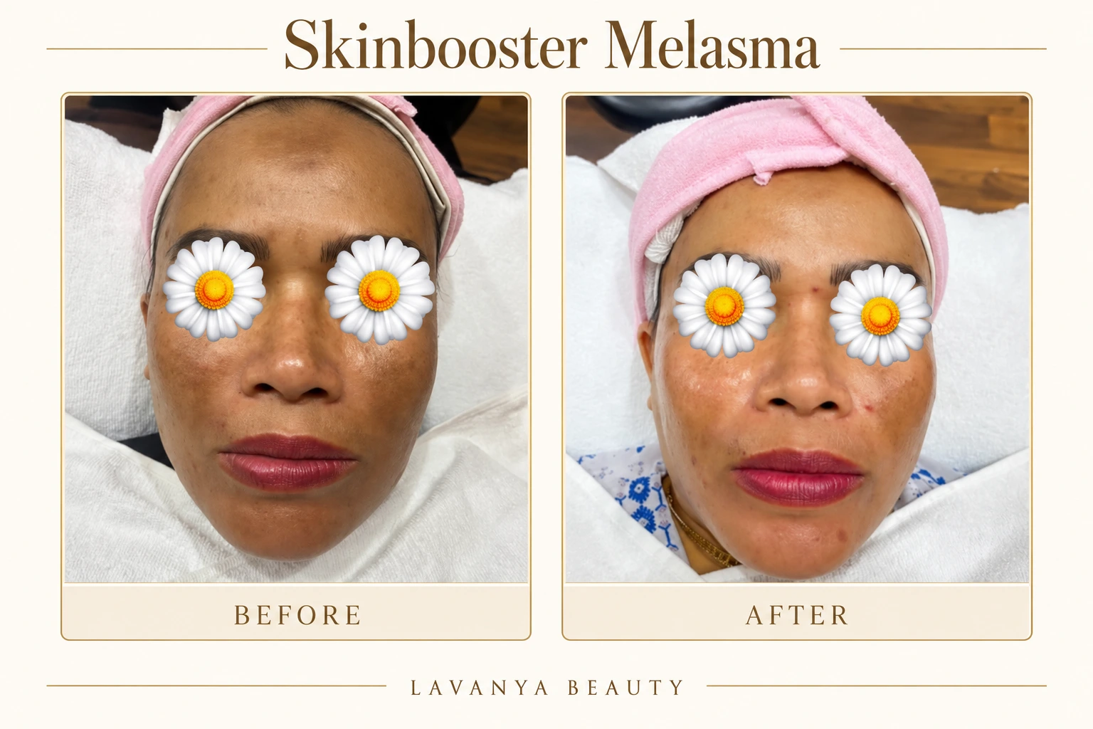 Perbandingan sebelum dan sesudah Skinbooster melasma