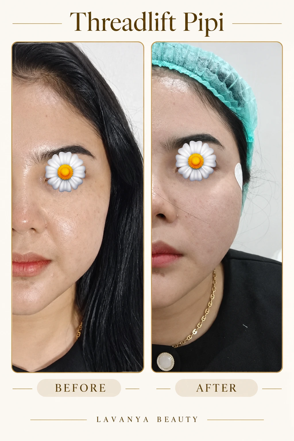 Perbandingan sebelum dan sesudah Threadlift Pipi